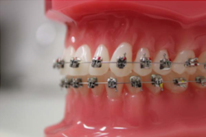 braces Point Cook