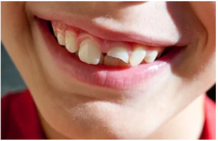 cracked teeth point cook