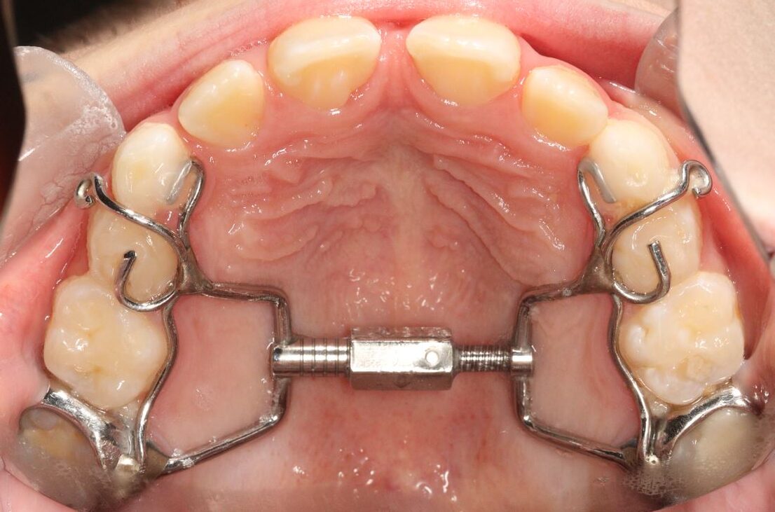 Palate expander kids melbourne